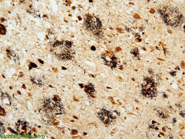 Alzheimer's disease, hippocampus, King Silver stain x200
